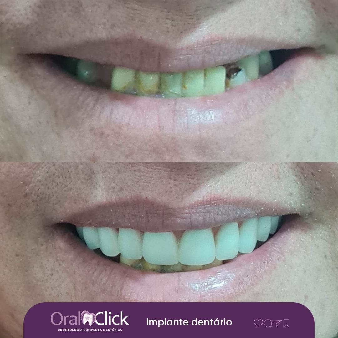 antes-e-depois-oral-click-implante-1.jpg