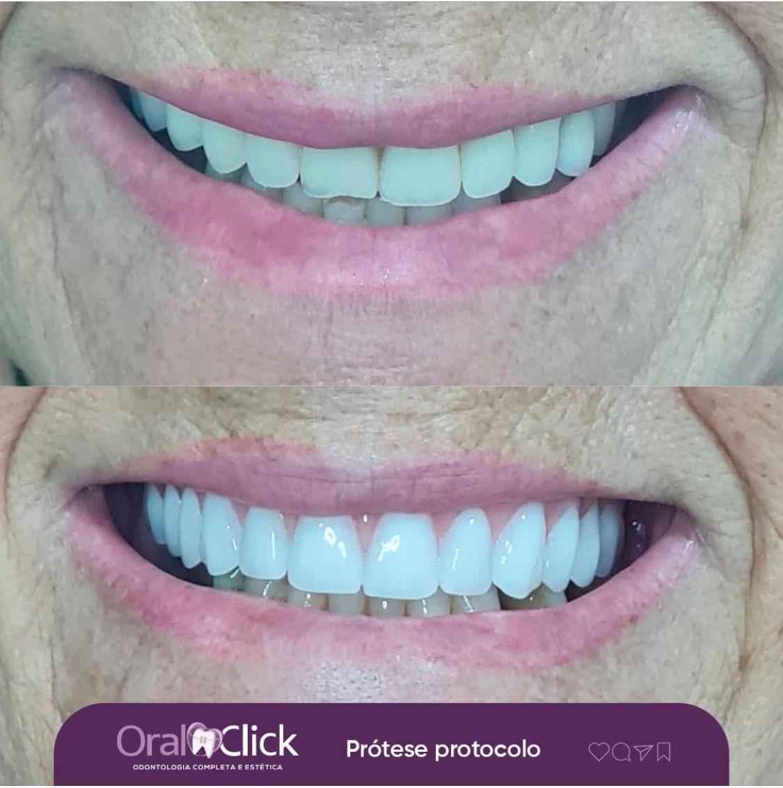 antes-e-depois-oral-click-implante-10.jpg