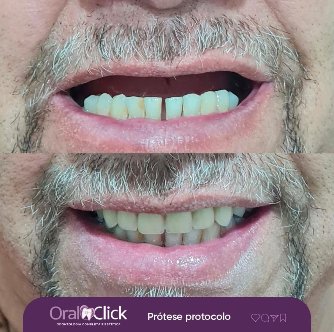 antes-e-depois-oral-click-implante-11.jpg