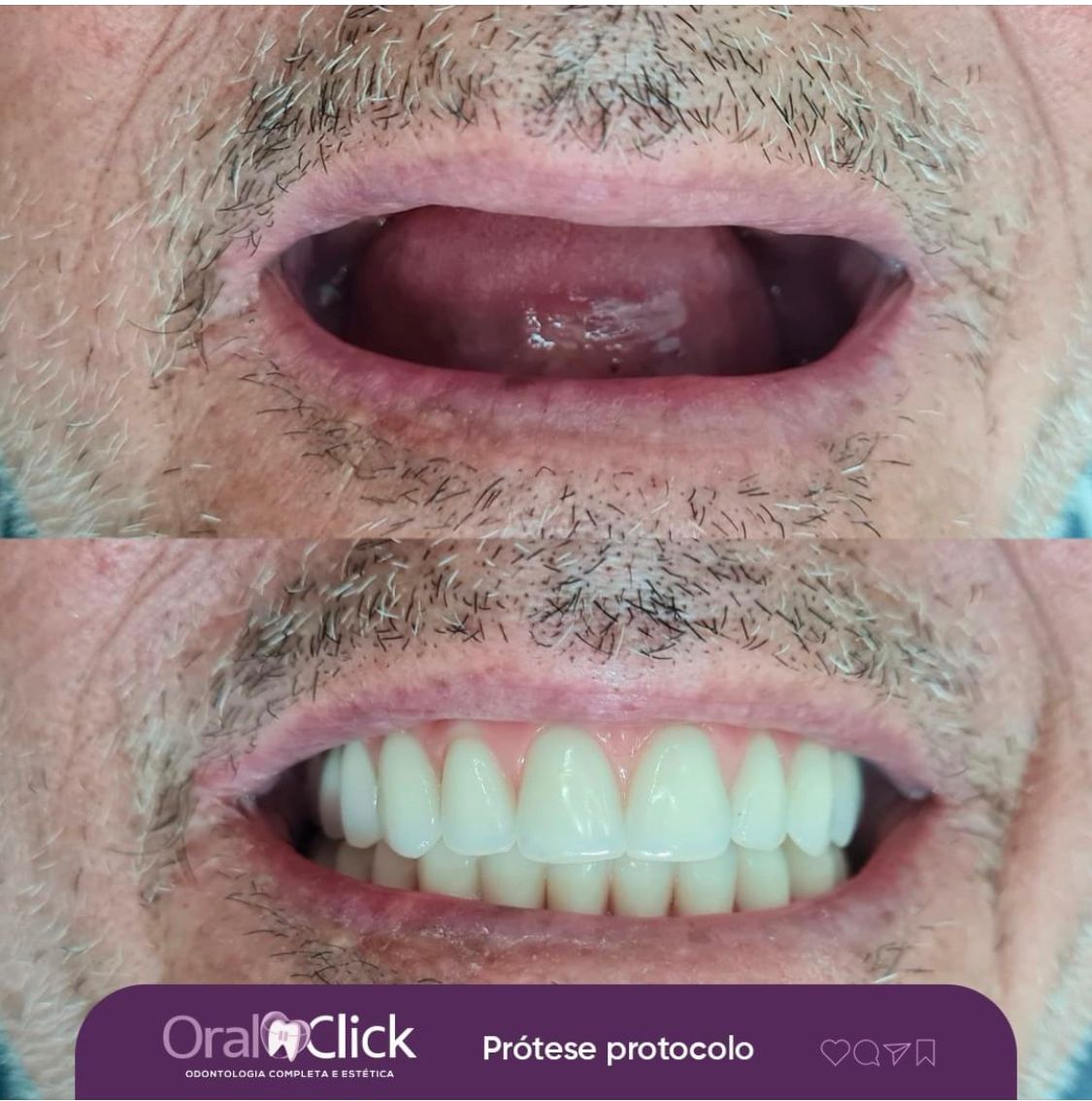 antes-e-depois-oral-click-implante-12.jpg