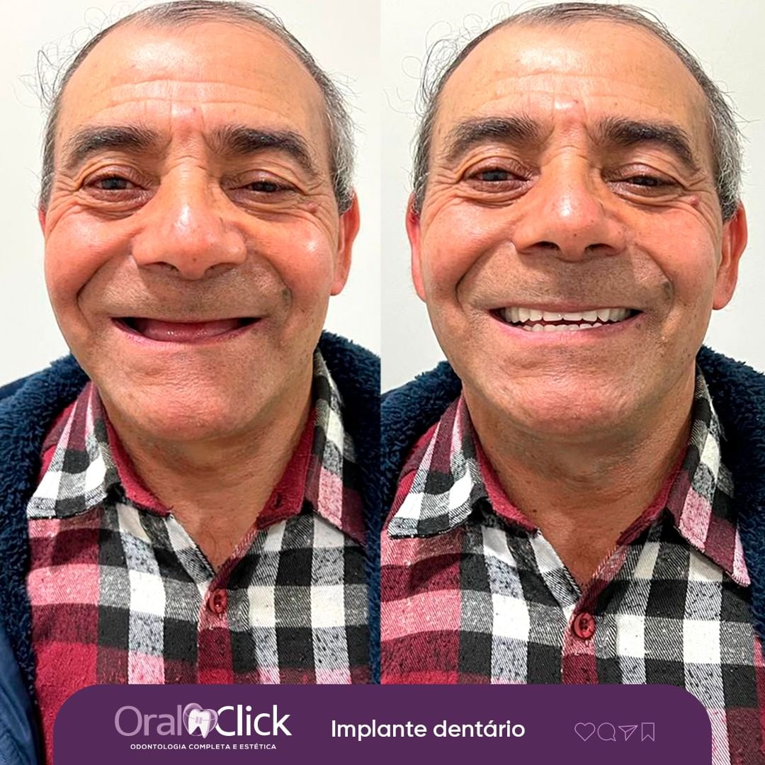 antes-e-depois-oral-click-implante-2.jpg