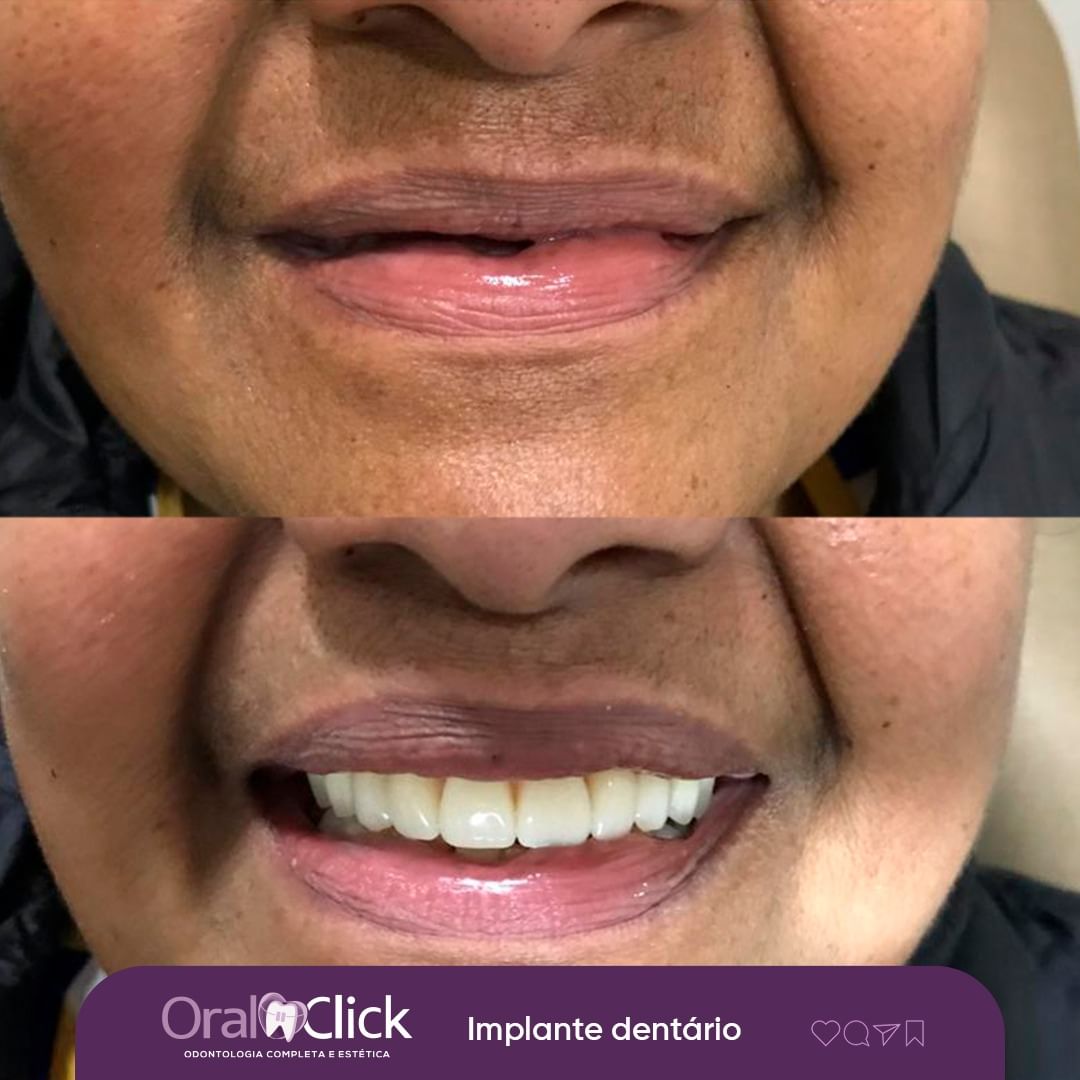 antes-e-depois-oral-click-implante-3.jpg