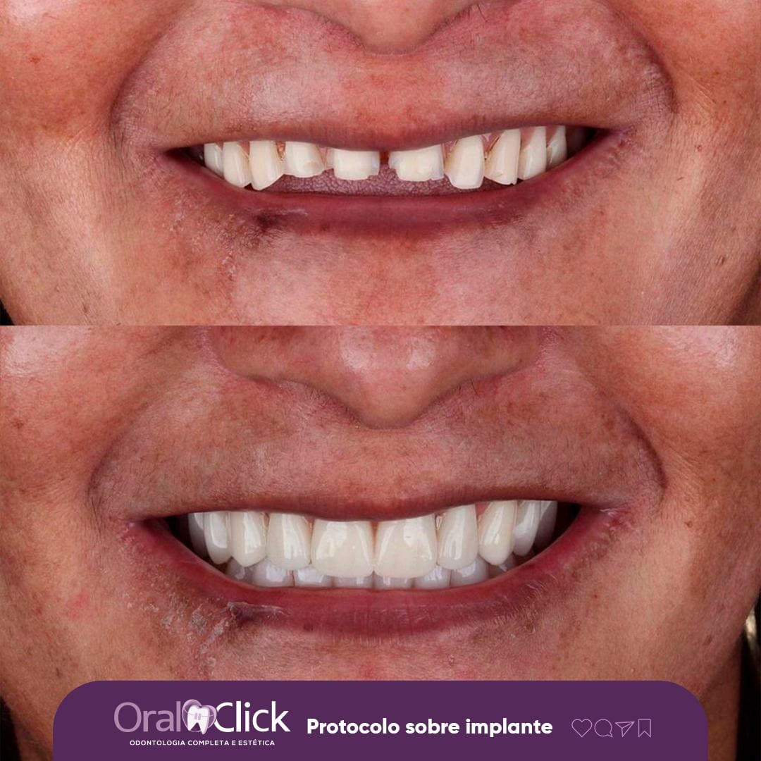 antes-e-depois-oral-click-implante-4.jpg