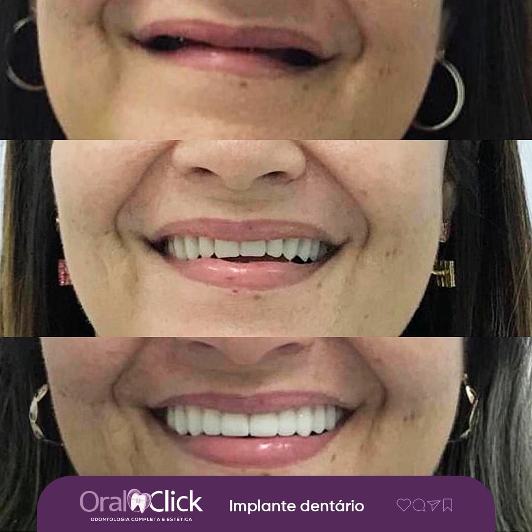 antes-e-depois-oral-click-implante-5.jpg