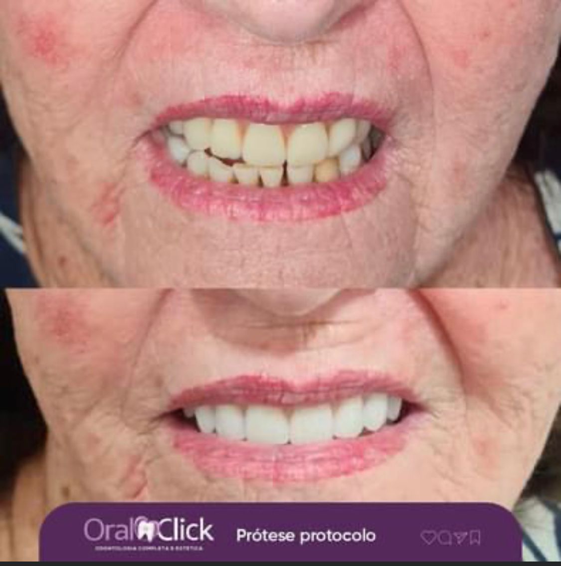 antes-e-depois-oral-click-implante-6.jpg
