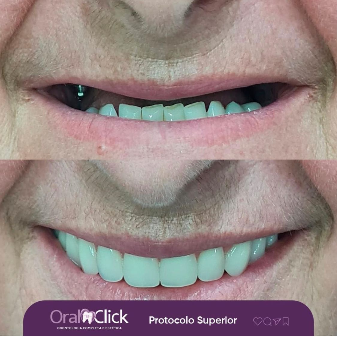 antes-e-depois-oral-click-implante-9.jpg