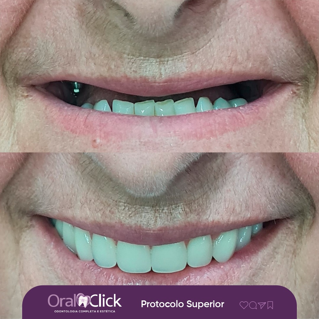 FOTOS ANTES x DEPOIS - Protocolo superior Rabbit 01