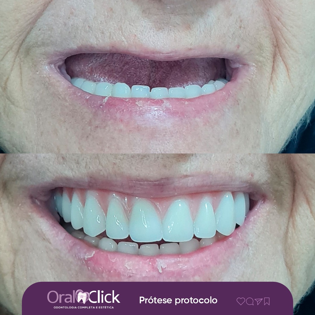 FOTOS ANTES x DEPOIS - Protocolo superior Rabbit 06